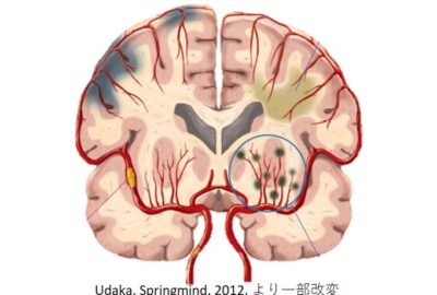 脳小血管病（小血管性認知症）について