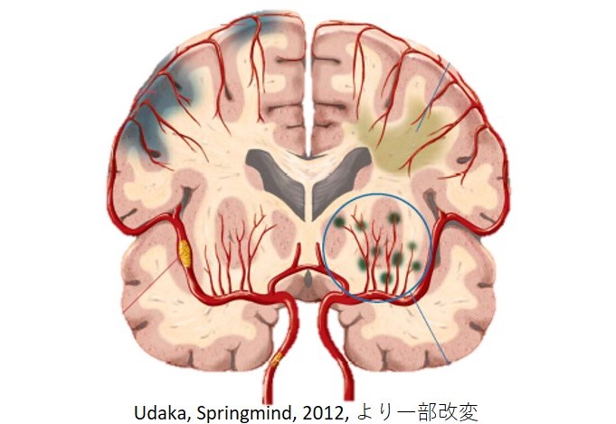 脳小血管病（小血管性認知症）について